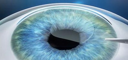 Small Incision Lenticule Extraction image