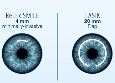 SMILE -- Our Newest Version of Small-Incision, Minimally-Invasive Lasik